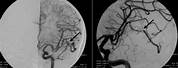 Cerebral Angiography of Hemorrhagic Stroke