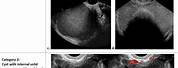 Complex Cyst On Ovary Cancer