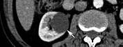 Complex Cyst in Kidney in CT Scan