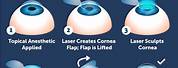 Lasik Eye Surgery Procedure