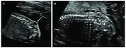 Meningocele Fetal Ultrasound