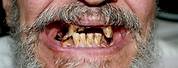 Meth Mouth