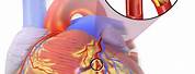 Myocardial Infarction Heart Image HD Images