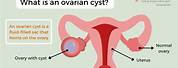 Ovarian Cyst 4 Cm in Size
