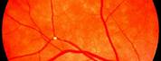 Retina Blood Clot