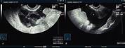 Sagittal R Adnexa Ultrasound