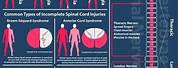 Slic Spinal Cord Injury