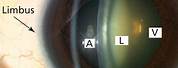 Slit Lamp Lens Retina