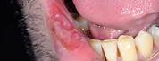 Syphilis Mouth Ulcer