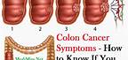 Top 10 Signs Colon Cancer