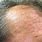 Actinic Keratosis On Forehead