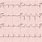 Acute Myocardial Infarction EKG