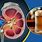 Alcohol and Kidney Disease