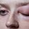 Allergic Eye Swelling