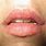 Allergic Reaction around Lips