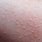 Allergic Skin Bumps