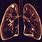 Apical Lung Nodule