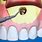Apical Surgery Dental