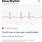 Apple Watch ECG Examples