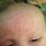 Baby Rash On Forehead