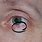Basal Cell Carcinoma Lower Eyelid