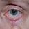 Basal Cell Carcinoma of Eyelid