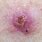 Basal Cell Skin Cancer Sore