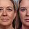 Botox Eye Bags Before After