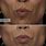 Botox for Lip Lines