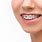 Braces On Protruding Teeth