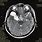 Brain Cyst MRI
