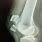 Broken Knee X-ray