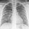 Bronchitis On X-ray