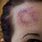 Bruise On Forehead