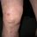Bruised Knee Cap