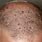 Bumps On Head Scalp