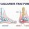 Calcaneus Bone Fracture
