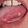 Cancerous Tongue