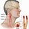 Carotid Artery Stroke Symptoms