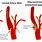 Carotid Artery Web