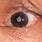 Cataract On Eye