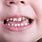 Cavity in Baby Teeth