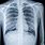 Chest X-Ray Lungs