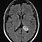 Choroid Plexus Xanthogranuloma MRI