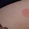 Circle Red Spot On Skin