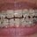 Clear Braces with Rubber Bands