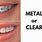 Clear or Metal Braces