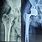 Complete Hip Replacement Surgery