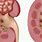 Complex Renal Cyst