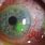 Corneal Ulcer Slit Lamp